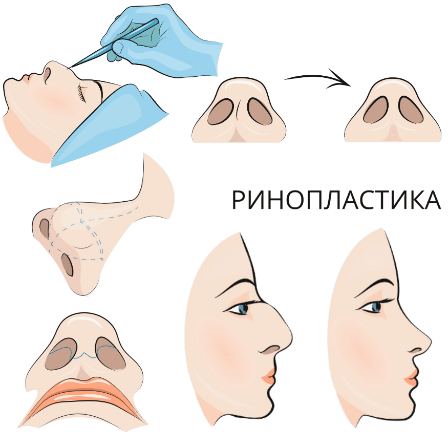 Иллюстрация: Ринопластика